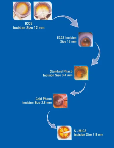 Oculoplasty oculoplasty